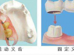 镶牙方式怎么选择