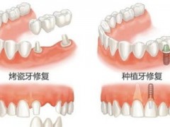 种牙和镶牙能使用多久