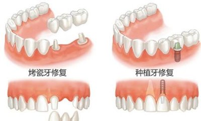 种牙和镶牙能使用多久