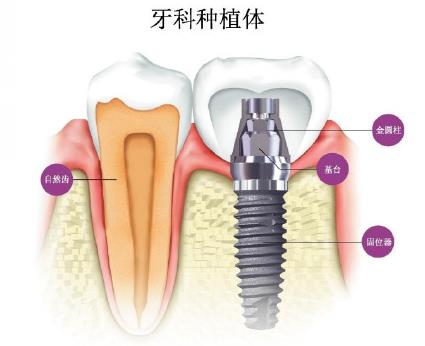 拔牙后要多久才能种植牙