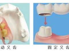 拔牙后要多久才能镶牙