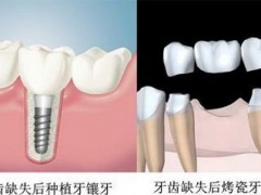 镶牙要多长时间