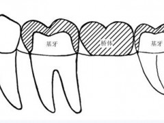 镶牙步骤有哪些