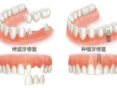 镶牙痛不痛