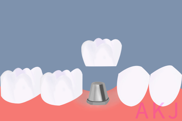 种植牙冠