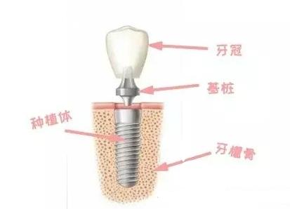 种植牙的结构