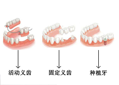 假牙的三种方式