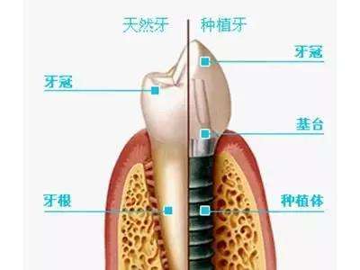 种植牙结构