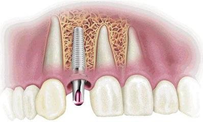 种植牙