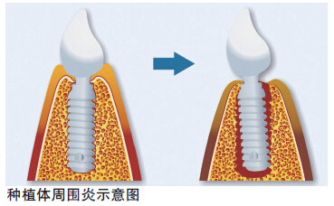 种植体周围炎示意图