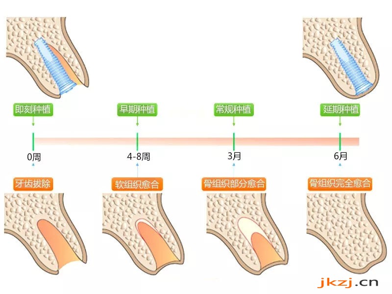 拔牙后种植牙