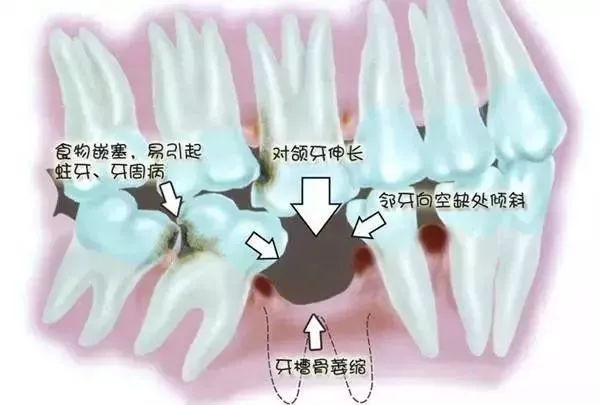 缺牙太久会造成的危害