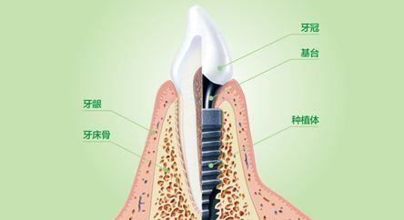 深圳种植牙一只多少钱