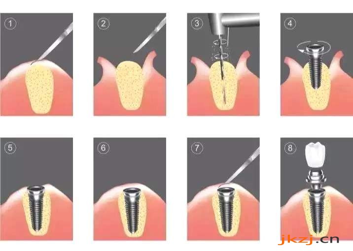 种植牙过程