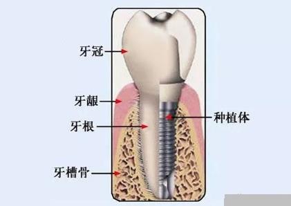 种植一颗牙需要的费用