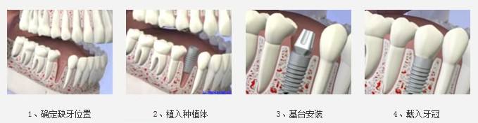 一颗种植牙大概多少钱,几千还是几万?