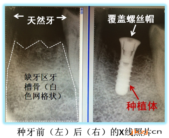 种植牙影响核磁检查吗