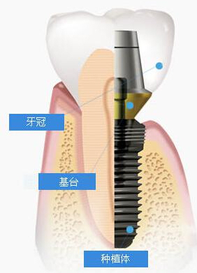 微创种植牙