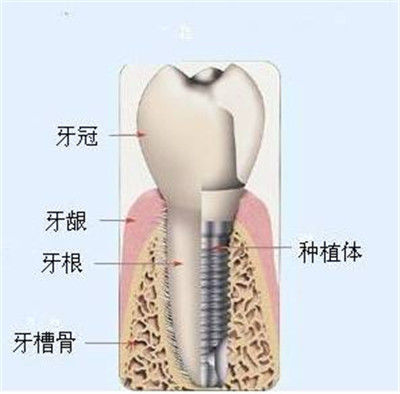 单颗种植牙多少钱