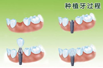 深圳种植牙多少钱一颗