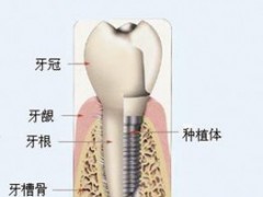 单颗牙缺失做种植牙好吗