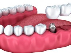 怎样选择安全可靠的种植牙