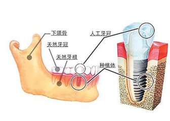 种植的牙价格
