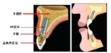怎么得到便宜的种植牙