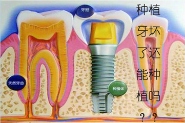 种植牙失败了怎么办