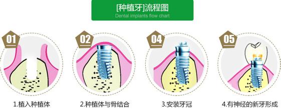 种一颗牙齿的价格