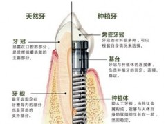 种植牙都有什么牌子