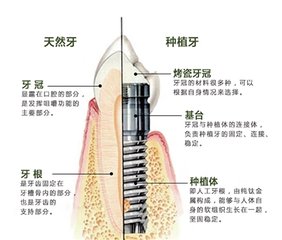 种植牙都有什么牌子