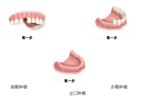 种植牙使用寿命多久