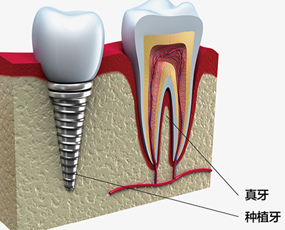 深圳种植牙哪里好
