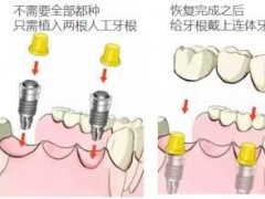 种2颗牙做桥是什么意思