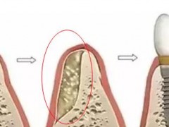 牙齿的骨量不够是什么意思