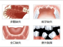 种植牙多颗、半口或者全口，价格有没有优惠?