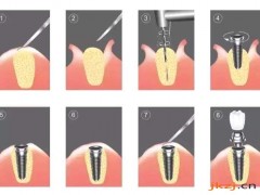 老人做种植牙担心价格贵还受罪，需要提前了解这些