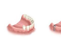 多颗牙齿缺失危害有多大