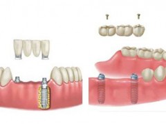 多颗牙齿缺失怎么选择修复方式？