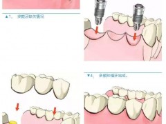 连续缺了3颗牙，怎么做种植牙?
