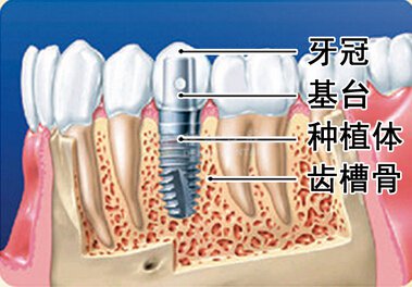 种植牙术后可以喝水吗