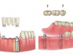 多颗牙没了什么补牙方法好