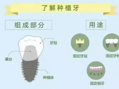 多颗牙种植价格