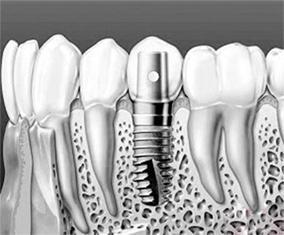 种植牙