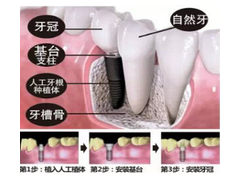 深圳人工种植牙齿多少钱