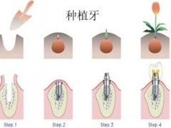 深圳半口牙缺失做种植牙多少钱