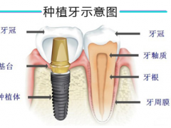 为什么缺失牙修复都选种植牙？