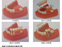 种植牙一般能“活”多久?