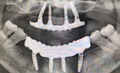 种植牙的X光图片